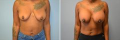 Patient 28 Before & After photos
