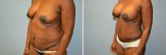 Patient 14 - Abdominoplasty and Breast Augmentation Before & After photos