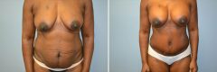 Patient 14 - Abdominoplasty and Breast Augmentation Before & After photos