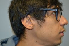 Gauged Ear Repair Patient 1 Before & After photos