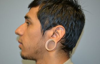 Gauged Ear Repair
