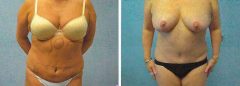 Tummy Patient 16 Before & After photos