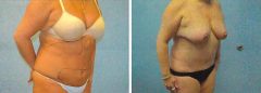 Tummy Patient 16 Before & After photos