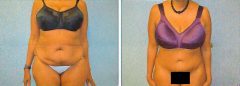 Tummy Patient 17 Before & After photos