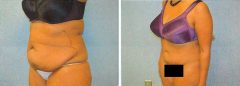 Tummy Patient 17 Before & After photos