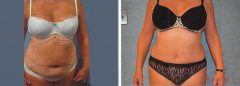 Tummy Patient 18 Before & After photos