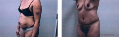 Patient 21 Before & After photos
