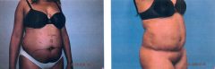 Patient 23 Before & After photos