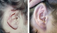 Ear Reconstruction Following Ear Trauma Patient 1 Before & After photos