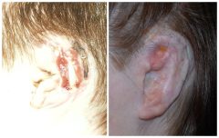 Ear Reconstruction Following Ear Trauma Patient 2 Before & After photos