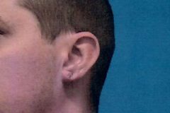 Gauged Ear Repair Patient 2 Before & After photos